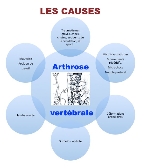 causes arthrose